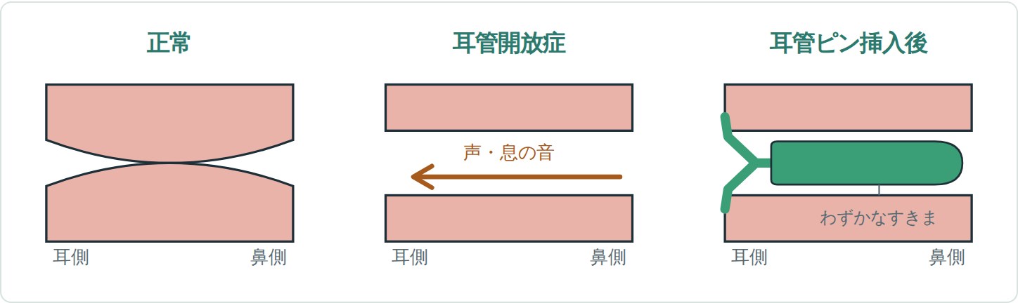 耳管の比較図。正常では閉じている。耳管開放症では開いたままで声や息の音が耳へ伝わる。耳管ピン挿入後はピンで管が適度に狭くなり、わずかなすきまが残る。